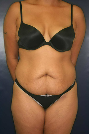 Liposuction